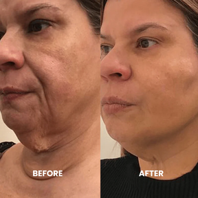 Luxe Micro Infusion System™