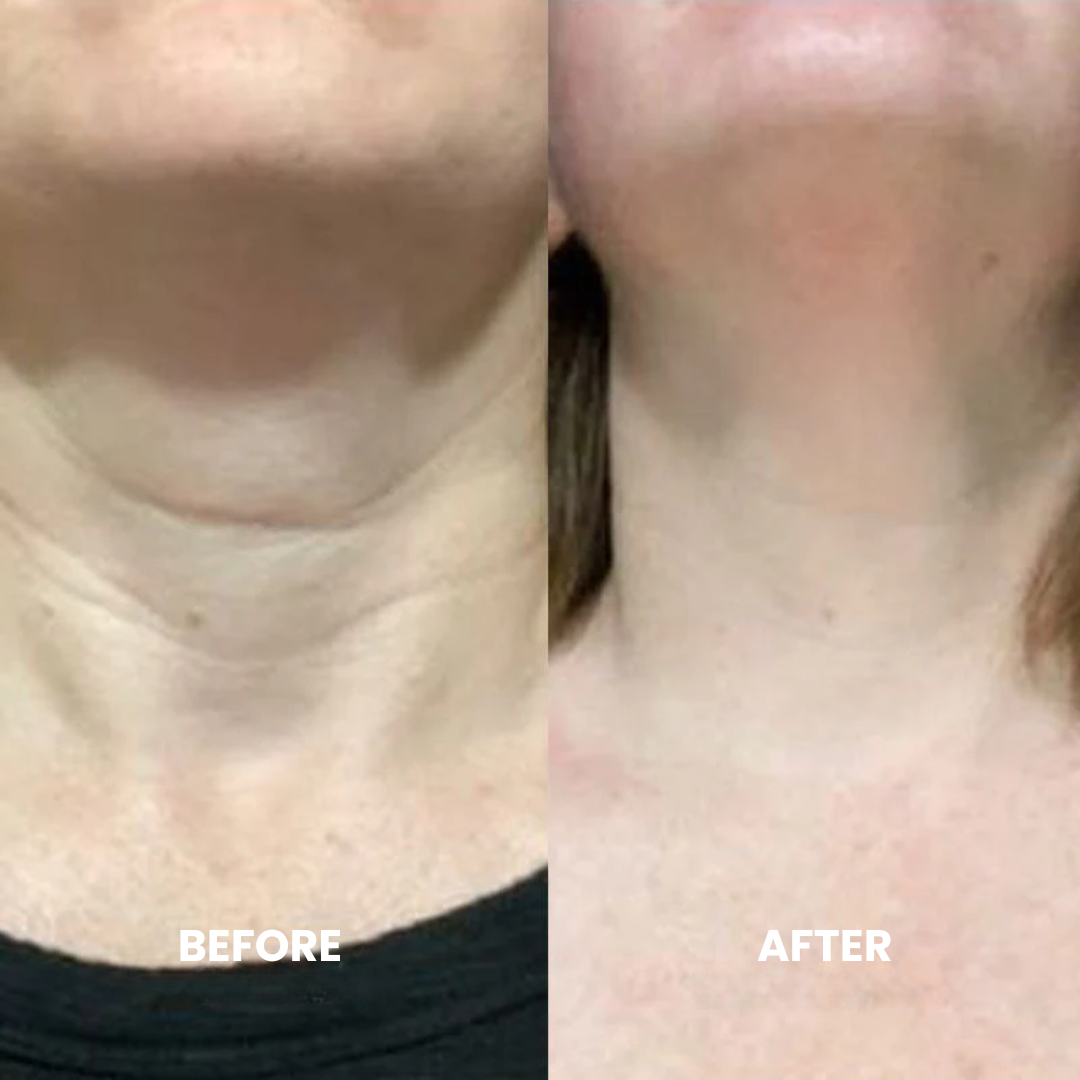 Luxe Micro Infusion System™