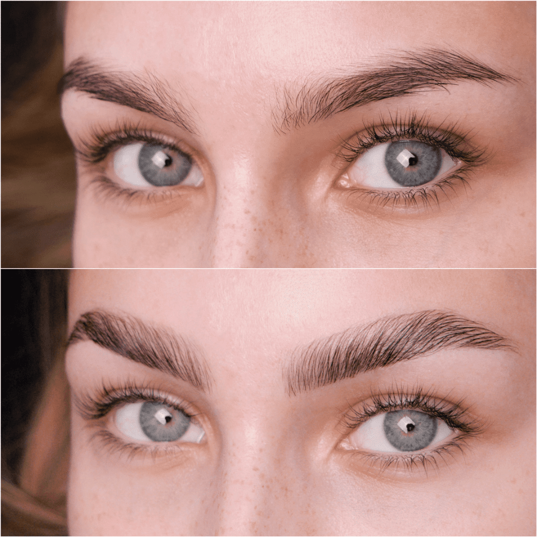brow lift before and after