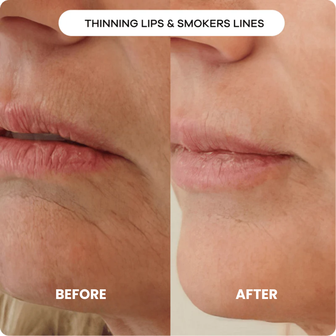 Luxe Micro Infusion System™